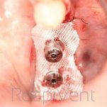 Stomatologia implanty z opatrunkiem hemostatycznym Bloodstop IX